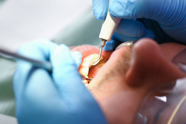 Best Emergency Dentist for Lost Fillings or Crowns in Moosup, CT